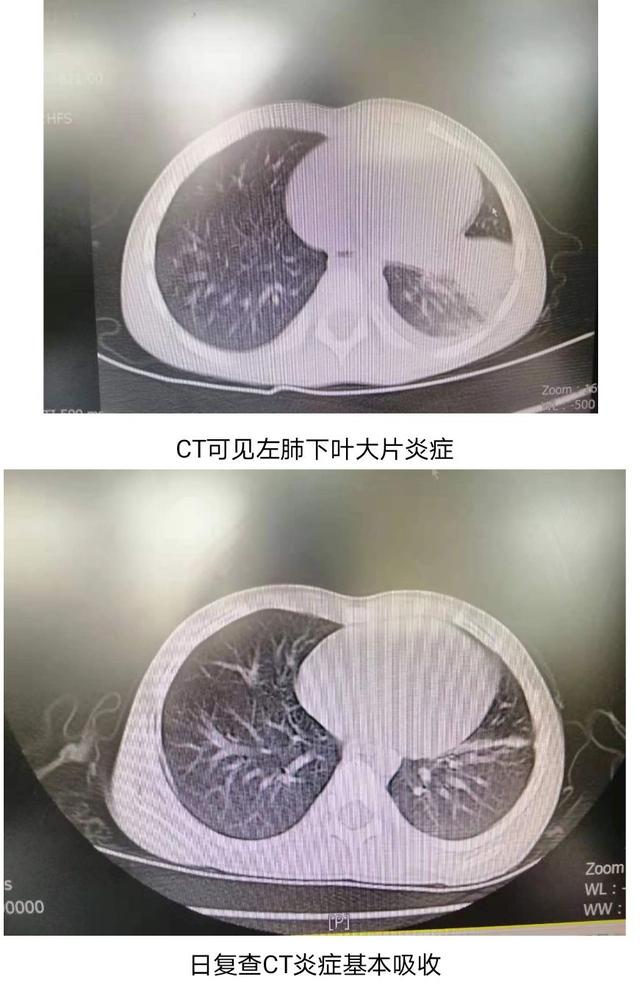 患儿|4岁娃高烧不退，青岛市立医院成功开展儿童支气管镜诊疗