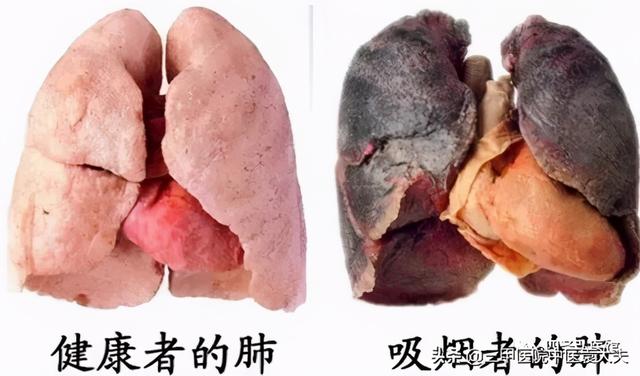 迈入中医之门第79篇：中医视角解读“慢性肺病论治”