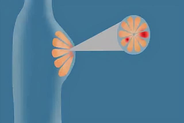 肿瘤医生：女性不想被乳腺癌“眷顾”，35岁后，1项检查别漏做