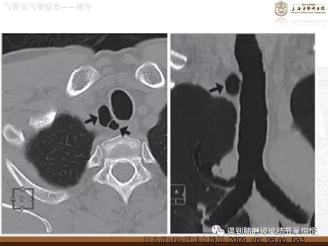 遇到气管、支气管憩室莫惊慌