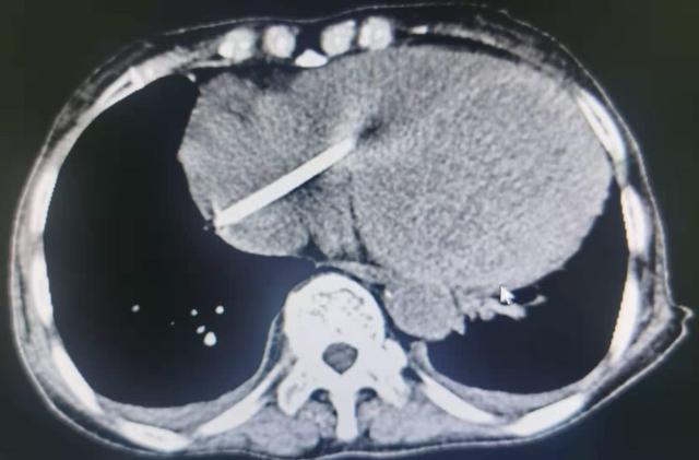 胆大！嫌脖子上的透析管碍事，七旬老太自己剪断了！部分导管“游”到了心脏