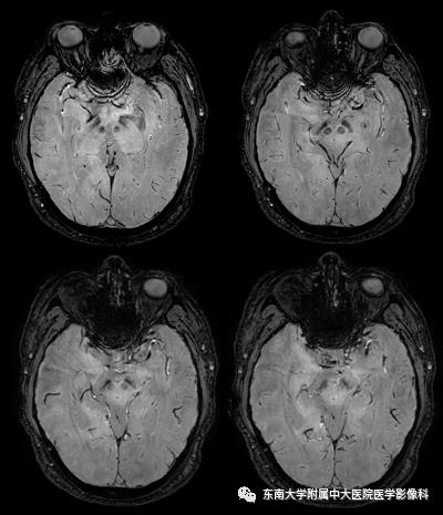 SWI的成像原理及相关病例随访