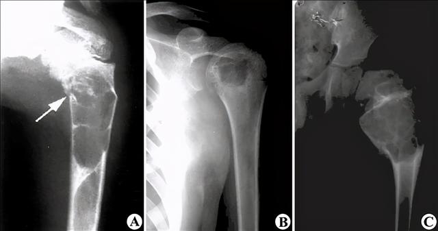 收藏 |：79种典型骨肌影像病例，助你诊断无忧