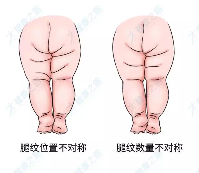「你的育儿经」这种常见的儿童“骨骼畸形”，很多家长没发现！医生4招教你辨别