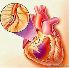 动脉粥样硬化|冠心病，吃什么药好呢？