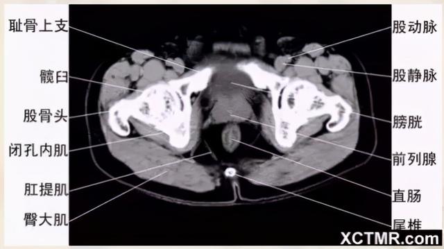 影像解剖：胸、腹部、盆腔CT解剖