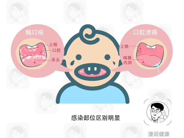 你的育儿经▲是鹅口疮还是口腔溃疡？宝宝口腔这些“小斑点”，教你6招来辨别