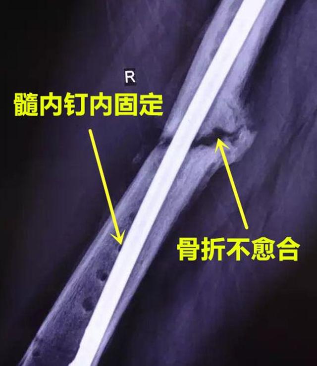 手术|「辟谣」手术是为了促进骨折愈合？错！敷中药往往更能促进愈合