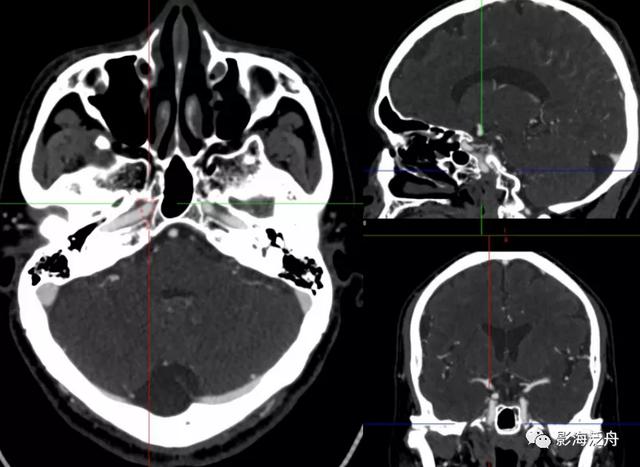 超实用的颈内动脉CTA分段
