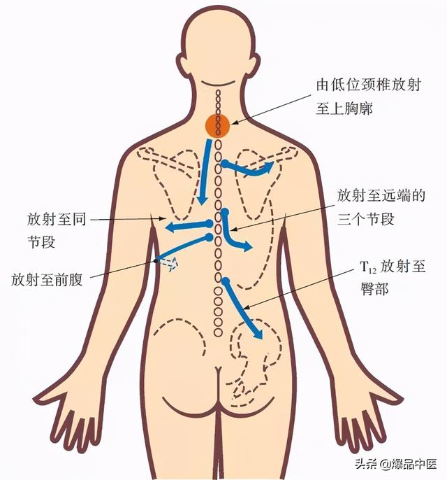 疼痛干货—全身筋结点，帮助诊治分析