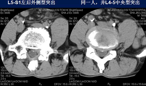 腰椎间盘CT诊断：椎间盘膨出、突出、椎管狭窄及退行性病变