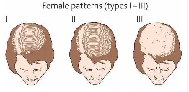 脱发常见的3种类型及应对办法，快来对号入座拯救头发