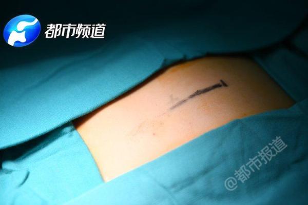 「光明网」扎心了！一岁宝宝心脏扎绣花针，凶手就在家里
