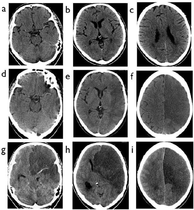 脑梗死患者的头部CT，你真的会看吗？丨实战读片