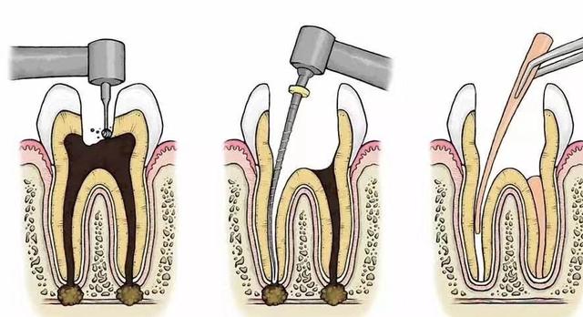 牙疼，不能着急吃止疼药，先得找准病因！有些牙疼只能杀神经
