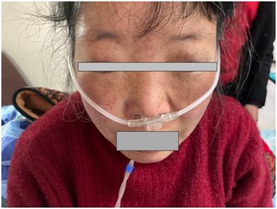 心脏|脚上一按一个坑！五旬大妈心上长了层“铠甲”，看医生如何化险为夷