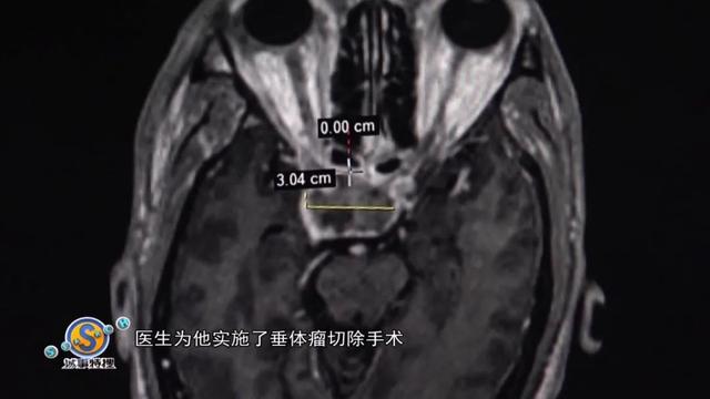 坤和|二次发育了？56岁男子身体突然出现奇怪变化