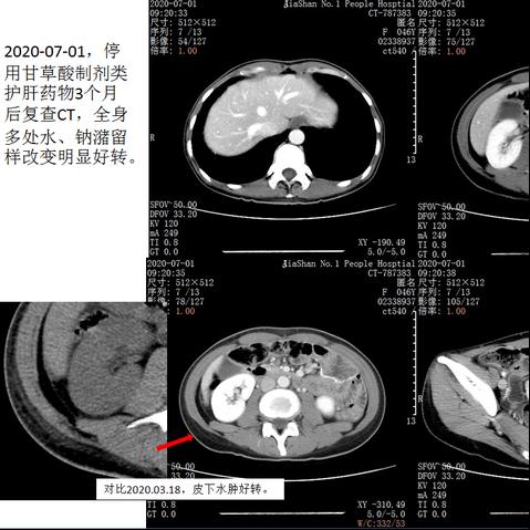 止咳药会成瘾？护肝药会水肿？