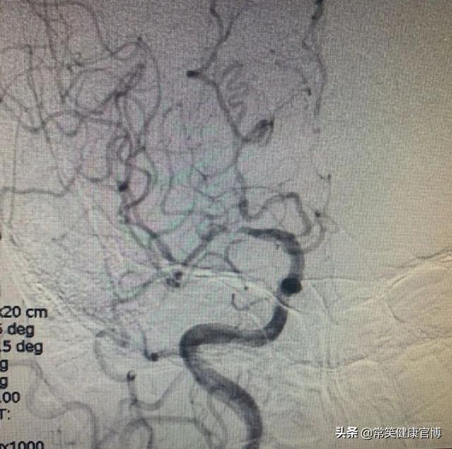 颅内血管狭窄——尹奶奶中风的原因