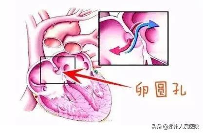 一“孔”不合，竟让血压蒙冤三十年