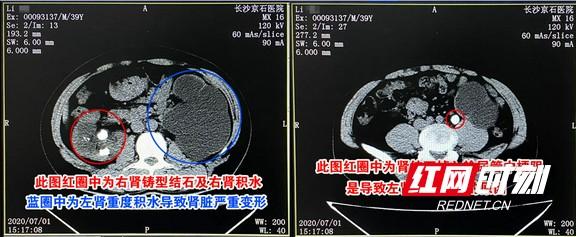 结石|发现肾脏小结石之后的正确做法 听听医生怎么说