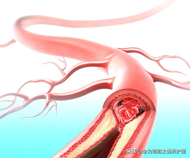 「干货」血液净化在急诊科应用中的常见问题