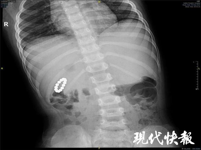 孩子误吞磁力珠，扬州这家医院接连收治3起