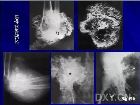 9个骨肿瘤医学影像诊断分析基本要点，如此精彩怎能错过