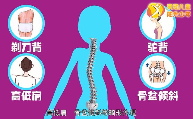 健康学堂|孩子高低肩，可能是病，这些脊柱侧凸自查方法，家长们一定要收藏