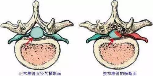 “骑车行百里，步行百步难”是什么病？骨科医生与您聊一聊