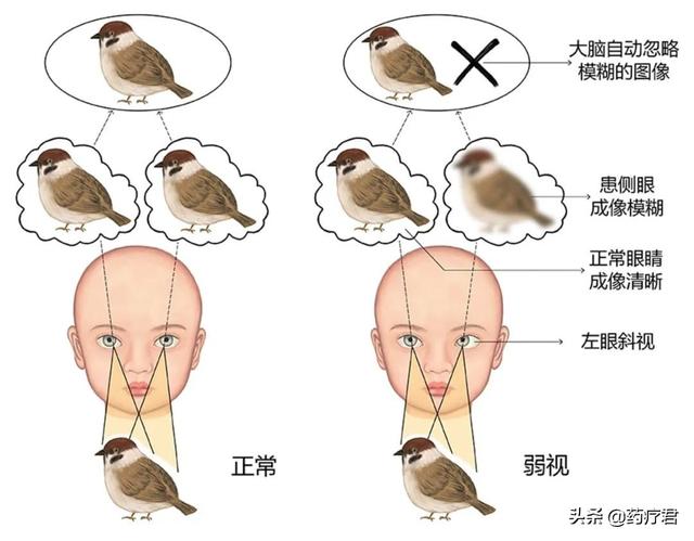 近2000万名儿童患有弱视！医生：弱视难发现，别耽误孩子一生