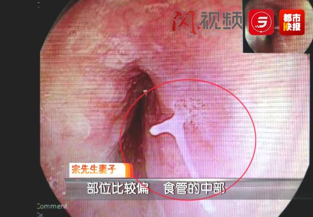 鱼刺|山西男子吃了顿饭差点要了命，紧急奔赴陕西求医，只因一根小小的……