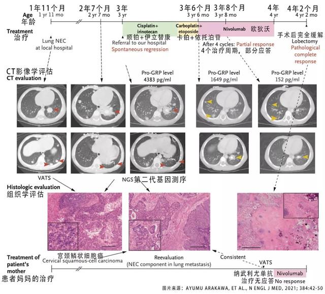 23个月大婴儿确诊肺癌，癌细胞来自母亲