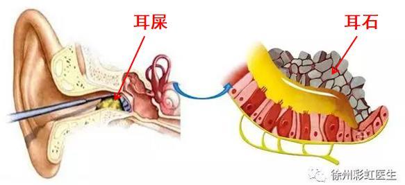 天旋地转|反复头晕眩晕？脑科医生：不一定是脑子有问题，病根有可能在耳朵