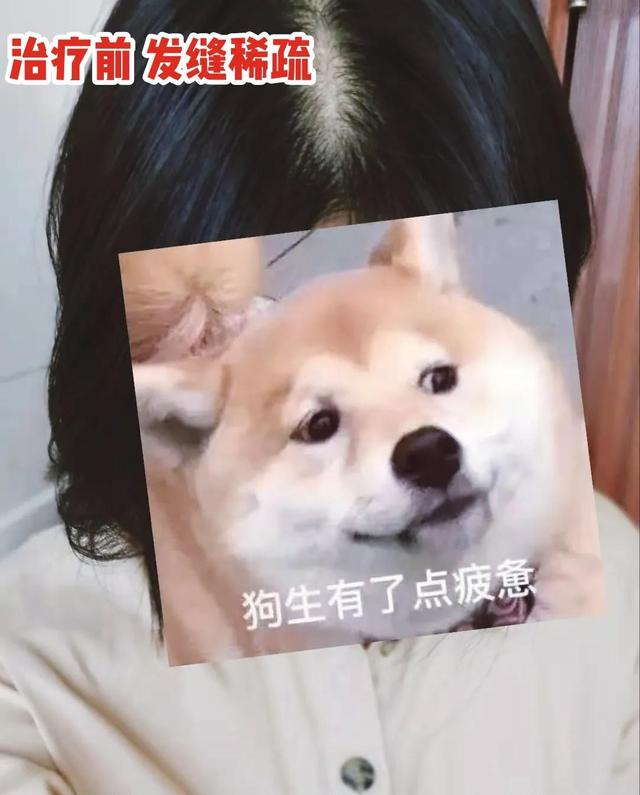 非那雄胺的真实有效率是多少（五位发友改善一年，终于告别稀疏）