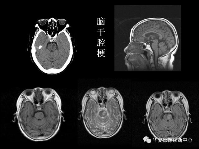 「影像复习」脑干区常见病变影像表现