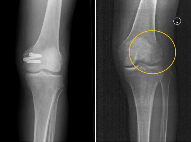 螺钉|世界首款！人体可降解医用蚕丝骨钉在陕成功应用