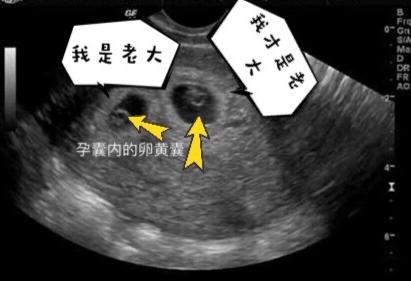 你的育儿经@早孕期双胞胎超声怎么看？