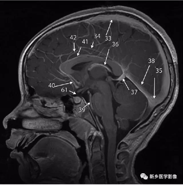 大脑中线处常见的25种疾病