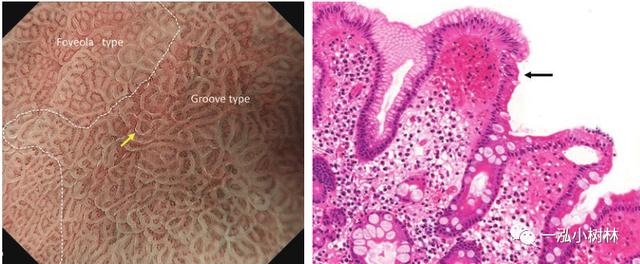 肠上皮化生的放大内镜与病理图像 | 内镜集锦