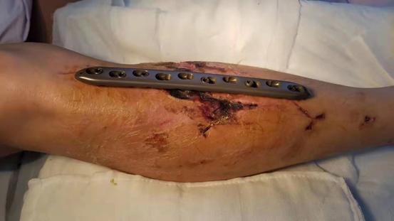 手术|鲁东医院骨科团队妙用钢板外置微创治疗复杂开放性骨折