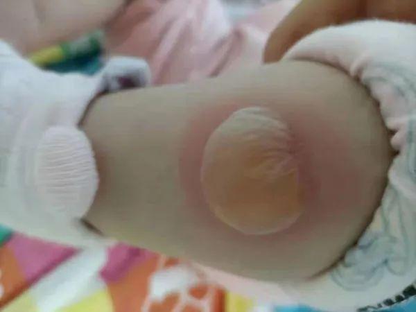 女士|推拿馆做艾灸治疗感冒，银川半岁女婴两条小腿深二度烫伤……