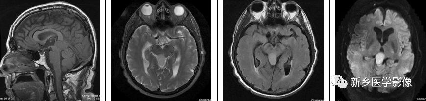 12种松果体区肿瘤的影像表现