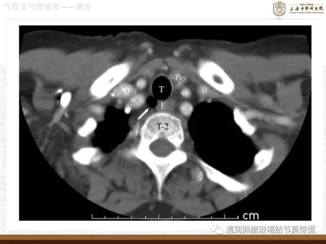 遇到气管、支气管憩室莫惊慌