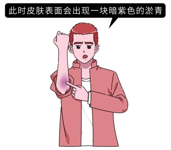 女生的膝盖总是有淤青，背后的原因是什么？为什么男生很少有？