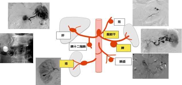 内脏|太蹊跷！三年体内连续多次出现内脏动脉瘤