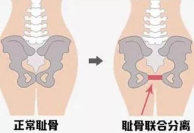 「你的育儿经」孕期最难熬的“耻骨痛”，只有经历过的孕妇才知道，痛起来真要命