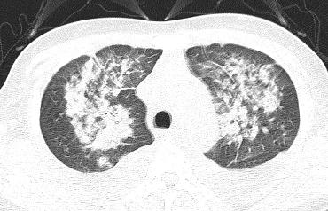 「典型」的肺水肿，为何用抗生素狂轰滥炸？