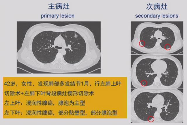 单发结节和多发结节哪个更危险？有好几个结节，要做多少次手术？