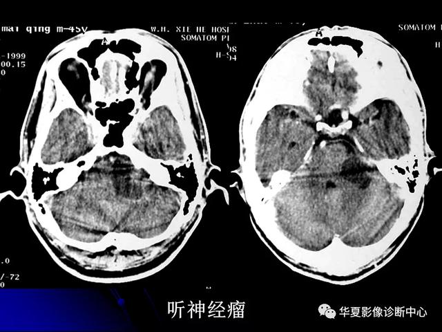 「影像复习」脑干区常见病变影像表现